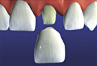 Hilliard Ohio Dental Crowns