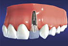 Dental Implants Hilliard - Upper Arlington OH